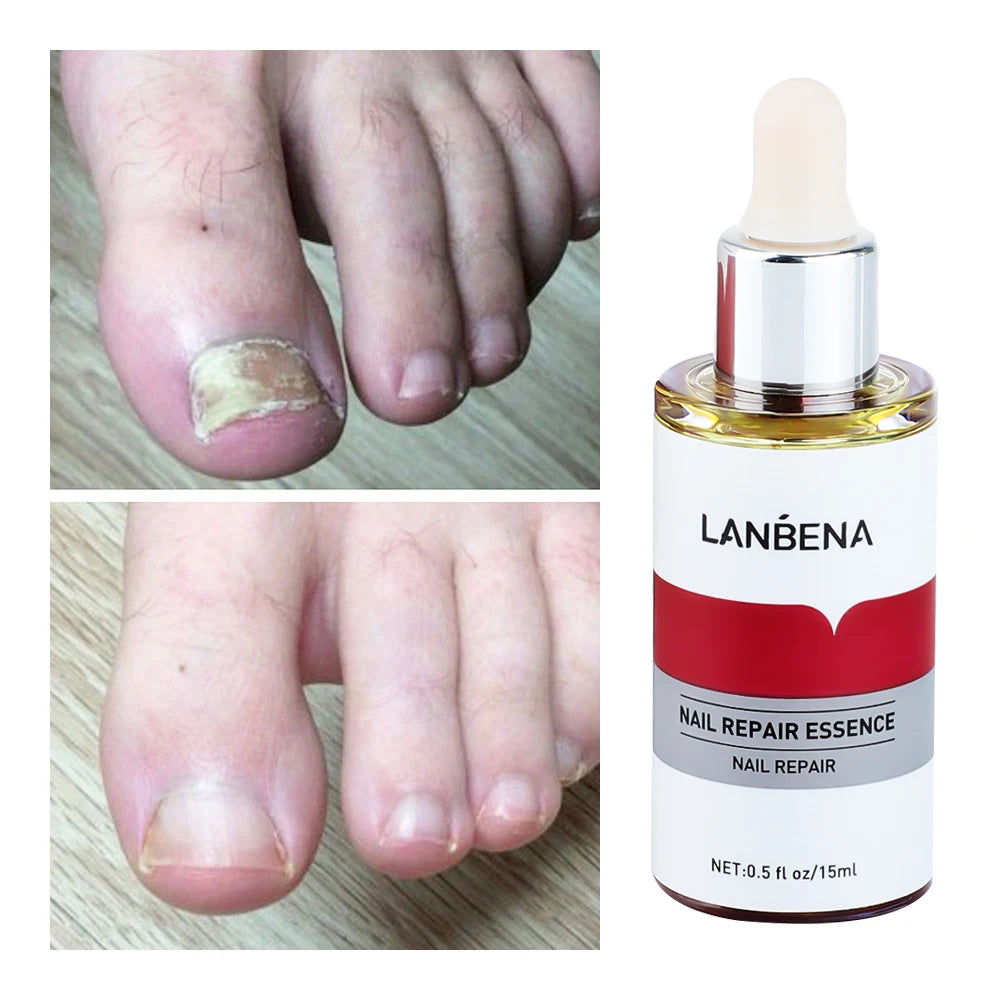 Nail Fungal Treatment Essence Oil Foot Toe Nail Fungus Removal Serum Repair Onychomycosi Anti Infection Gel Care Products