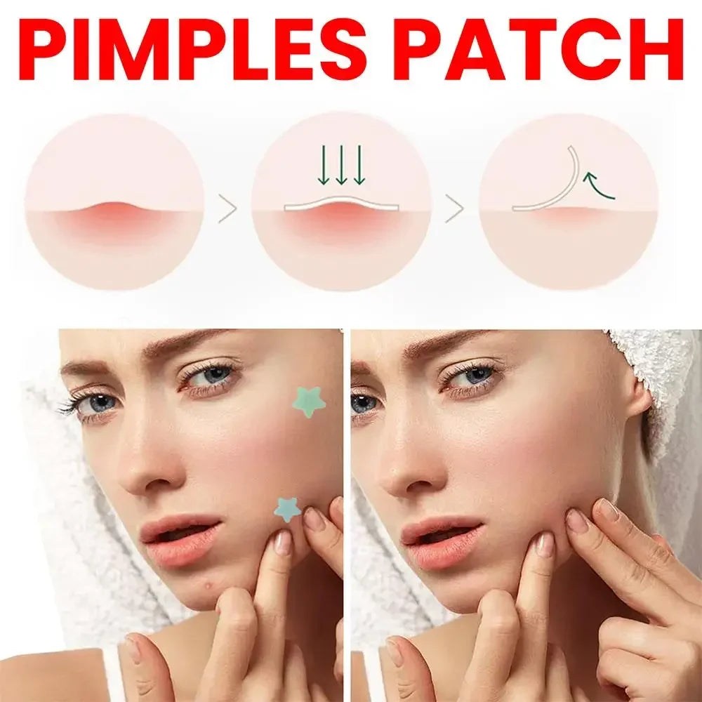 BOLUOYIN - 200 Patches Anti Acne Invisible Stickers Pimple Removal