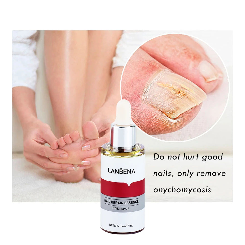 Nail Fungal Treatment Essence Oil Foot Toe Nail Fungus Removal Serum Repair Onychomycosi Anti Infection Gel Care Products