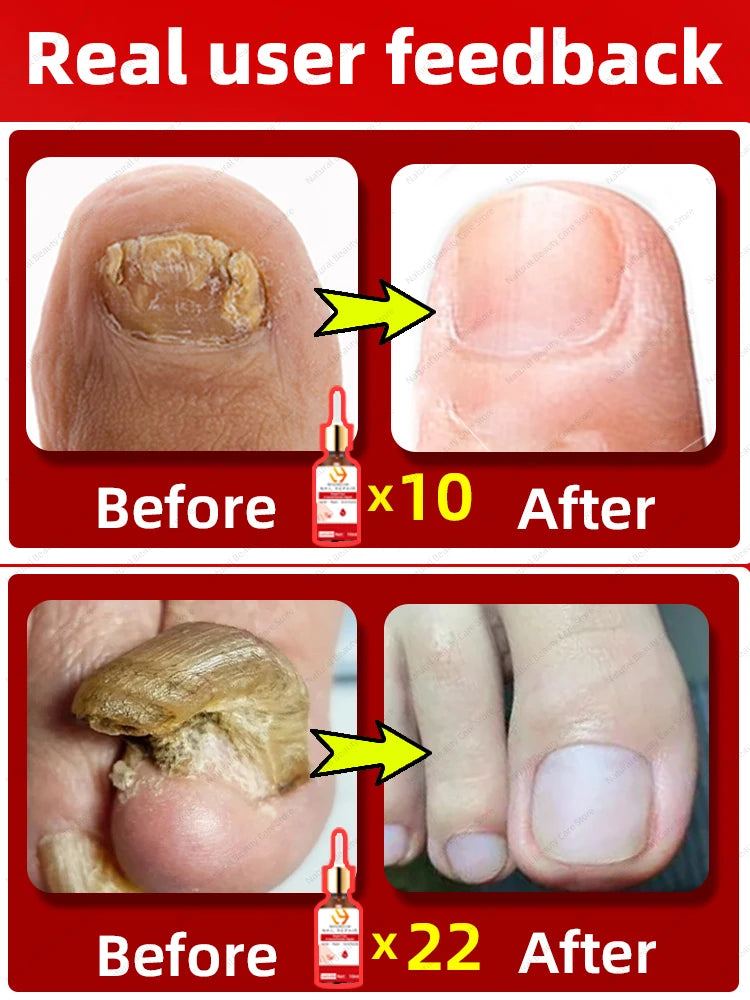 Fungal Nail Repair Fast Onychomycosis Fungus Nails