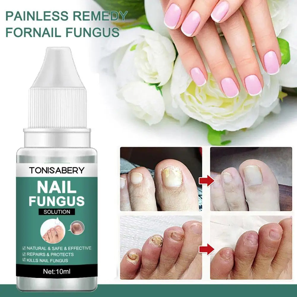 Nail Fungal Treatment Feet Care Essence Anti Infection Onychomycosis Removal Toe Nail Foot Fungus Paronychia Nail Care Body T4X8